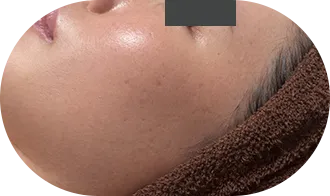 ハーブピーリング3ヶ月後：ニキビ跡が目立たない健康的な肌へ